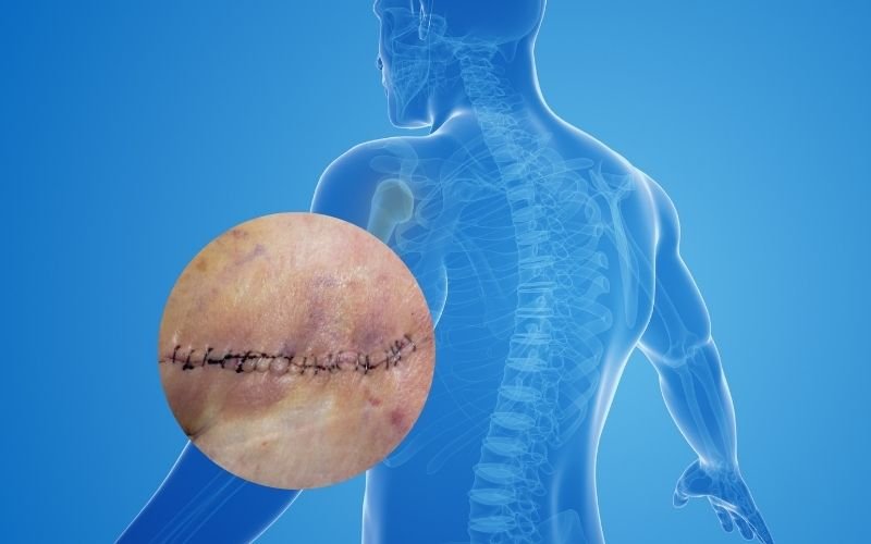 shoulder replacement surgery
