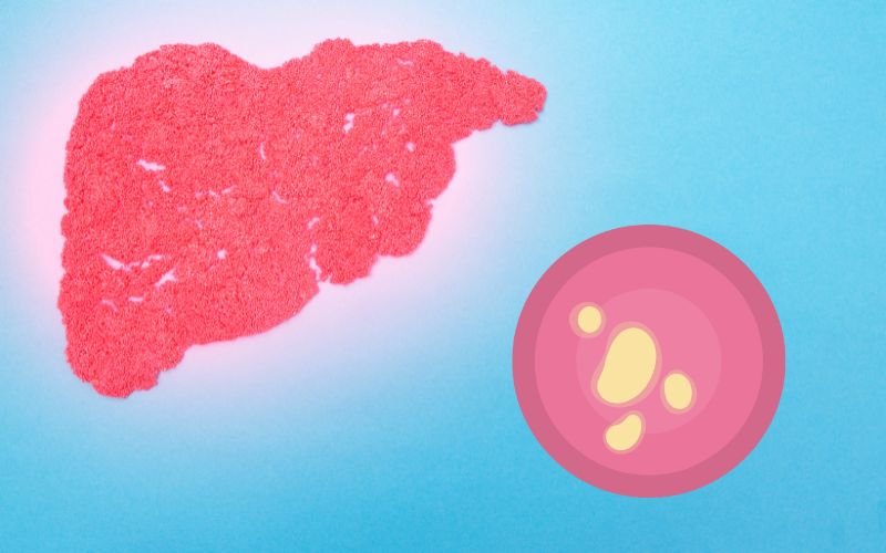 Liver Abscess treatment in delhi