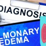 Pulmonary Edema treatment in Delhi