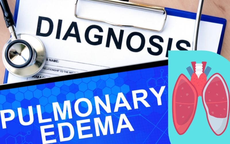 Pulmonary Edema treatment in Delhi