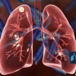 types of lung infections