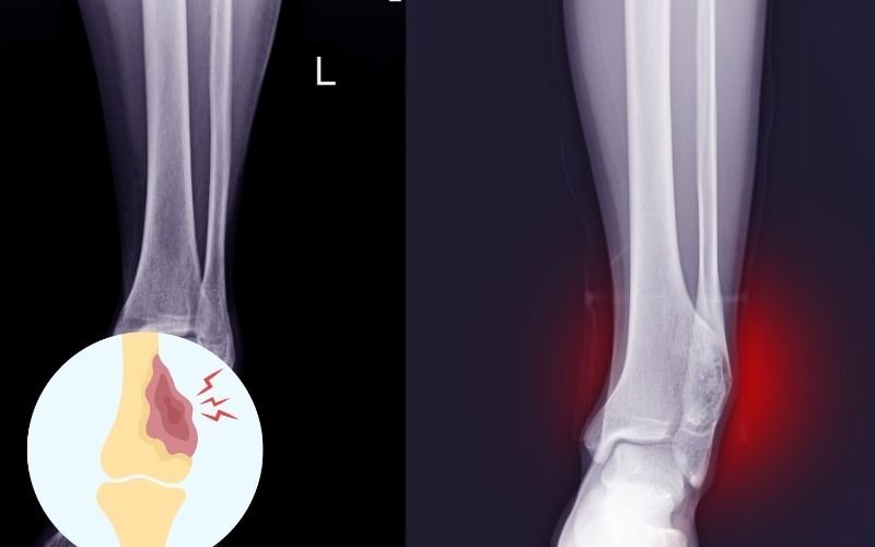 Osteochondroma treatment in Delhi
