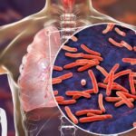 Tuberculosis treatment at pulmonology hospital in Delhi