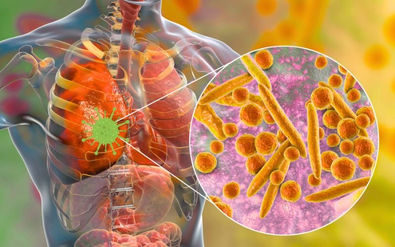 Pneumonia in adults Major causes and treatment in Delhi