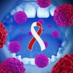 stages of oral cancer and treatment in delhi