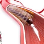The difference between angioplasty and angiography and angiogram