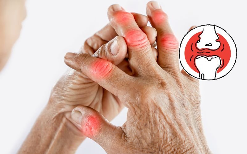 Can arthritis be cured permanently