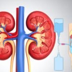 glomerulonephritis-treatment-at-nephrology-hospital-in-delhi