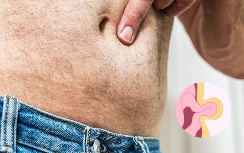 Hernia treatment without surgery in Delhi