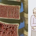 Can Osteoporosis Be Cured Orthopedics Treatment in Delhi