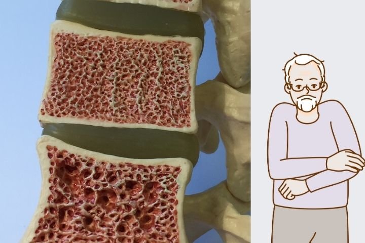 Can Osteoporosis Be Cured Orthopedics Treatment in Delhi