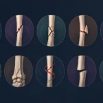 All types of bone fractures and best fracture treatment in Delhi
