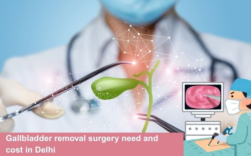 Gallbladder removal surgery need and cost in Delhi